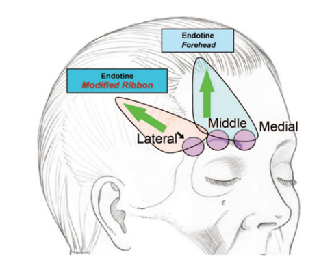 Drooping Eyelid Surgery: A Complete Guide to 3 Methods image 3