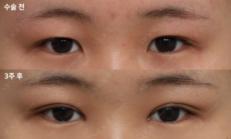 If the inner corner of your eyes feels cramped, consider this instead of Mongolian fold removal image 5