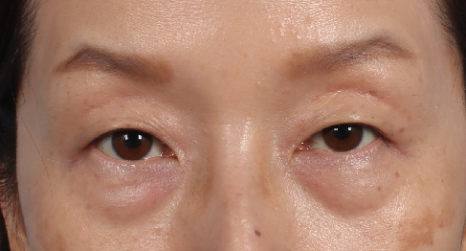 Drooping Eyelid Surgery: A Complete Guide to 3 Methods image 8
