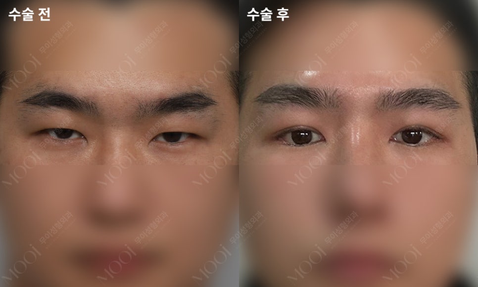 Three Things You Must Know Before Male Epicanthoplasty and Canthoplasty image 2