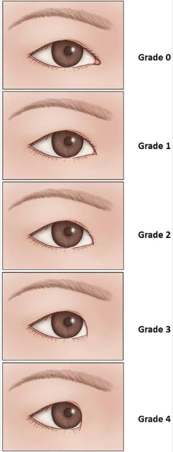 If the inner corner of your eyes feels cramped, consider this instead of Mongolian fold removal image 2