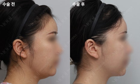안면윤곽수술 후 회복, 처음 2주가 결과를 만들어요 (뼈수술 관리법 총정리) 관련 이미지 2