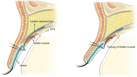 If a Double Eyelid Fold Comes Loose, Do You Need to Repeat Ptosis Correction Too? image 4