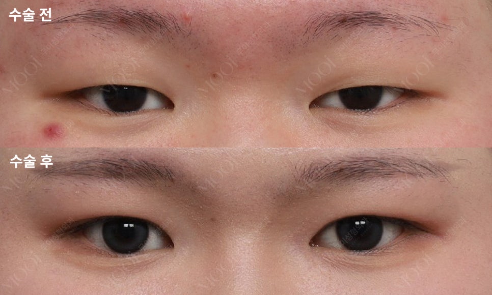 함몰눈 교정, 지방이식이 답일까? (지방이식 vs 지방재배치 선택 기준) 관련 이미지 7