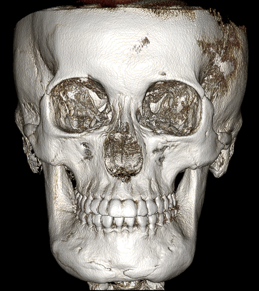 CRMO Patient Underwent Jawline Reduction Surgery — What Were the Results? Real Surgery Process Revealed, Part 2 image 1
