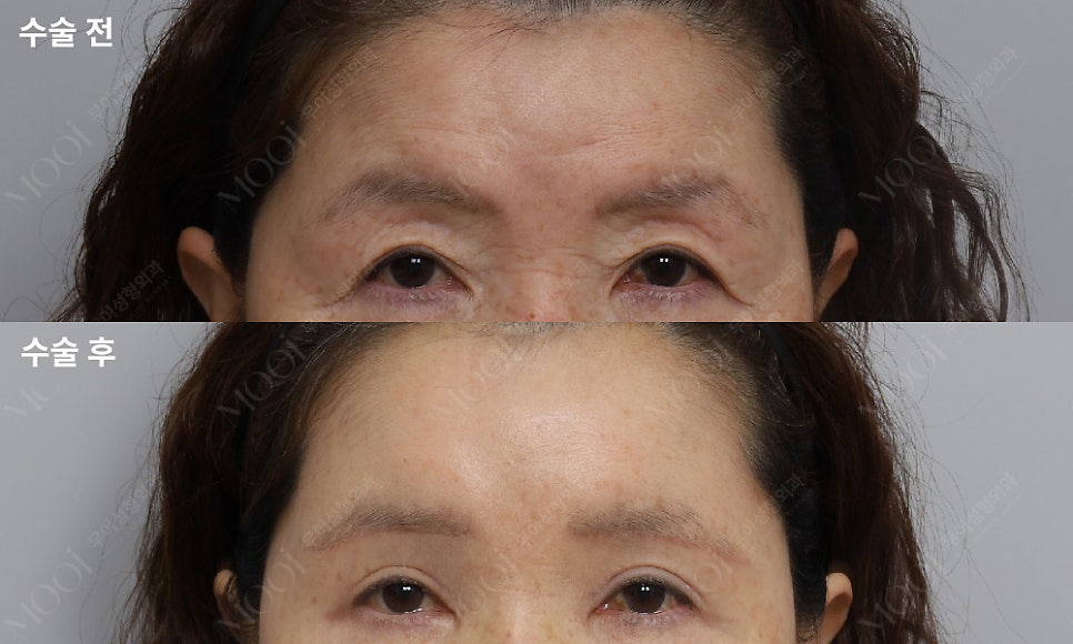 How to Find the Right Surgery for Drooping Eyelids (Upper Blepharoplasty vs Brow Lift Under the Eyebrow vs Endoscopic Forehead Lift) image 5