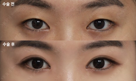 절개 비절개 눈매교정 차이, 나에게 맞는 건? 관련 이미지 4