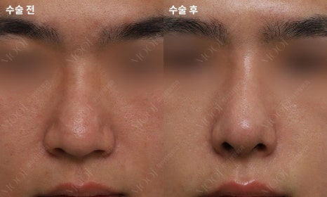 코재수술 늑연골: 자가늑/기증늑(동종늑연골) 어떤 경우에 선택할까 관련 이미지 10