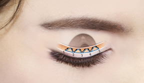Natural Adhesion vs. Incisional Double Eyelid Surgery: Which One Is Right for Me? | Complete Guide to the Differences Between Non-Incisional Double Eyelid Surgery image 3