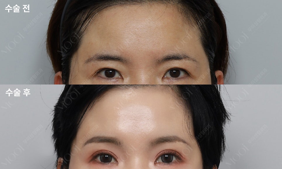How to Find the Right Surgery for Drooping Eyelids (Upper Blepharoplasty vs Brow Lift Under the Eyebrow vs Endoscopic Forehead Lift) image 3