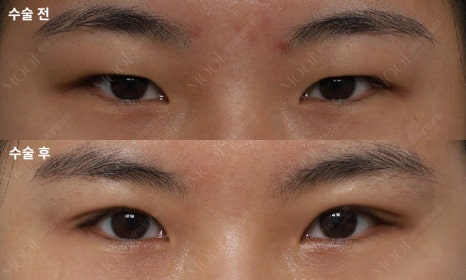 Monolid Epicanthic Fold Incision: Why Repositioning Is Needed Instead of Removal image 4
