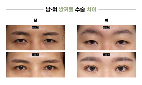 남자 쌍꺼풀 수술, 여자와 뭐가 다를까? (차이점 총정리) 관련 이미지 3