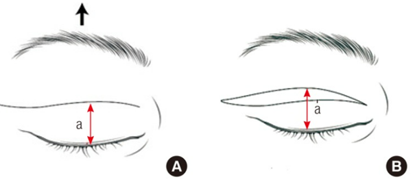 How to Find the Right Surgery for Drooping Eyelids (Upper Blepharoplasty vs Brow Lift Under the Eyebrow vs Endoscopic Forehead Lift) image 2