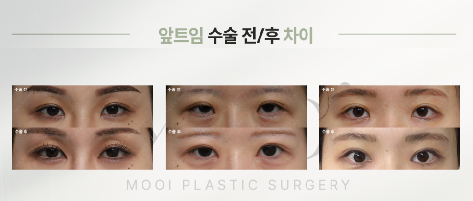 Do You Really Need Epicanthoplasty? Essential Checklist Before Your First Eye Surgery | Epicanthoplasty Side Effects·Cost image 2