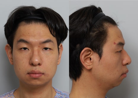 무턱, 턱끝 전진만으로 입체감이 생길까? 턱끝수술 실제 케이스 분석 관련 이미지 2
