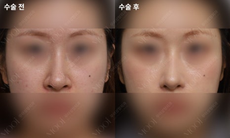Bulbous Nose Surgery: Is Raising Only the Nose Tip Enough? | Correction Checklist by Cause of Bulbous Nose image 14