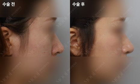 Bulbous Nose Surgery: Is Raising Only the Nose Tip Enough? | Correction Checklist by Cause of Bulbous Nose image 16