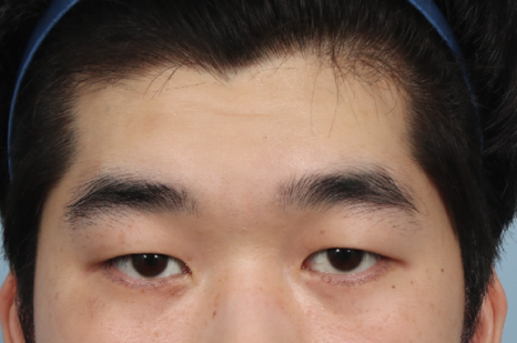 Drooping Eyelid Surgery: A Complete Guide to 3 Methods image 4