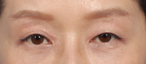 Drooping Eyelid Surgery: A Complete Guide to 3 Methods image 9