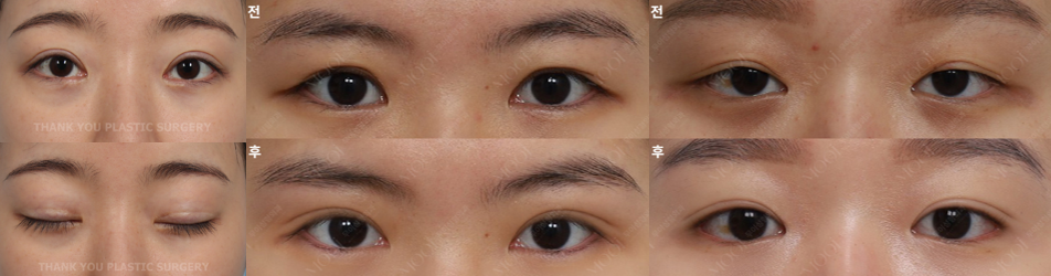 Double Eyelid Revision Surgery Cost: The Real Reason It’s More Expensive Than the First Surgery | What You Must Know Before Eye Revision Surgery image 2