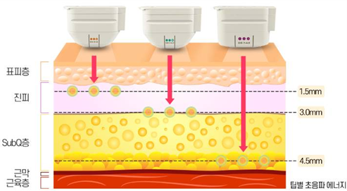 Non-Surgical Under-Eye Rejuvenation: A Complete Guide to Procedures and Effects image 5