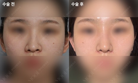 Bulbous Nose Surgery: Is Raising Only the Nose Tip Enough? | Correction Checklist by Cause of Bulbous Nose image 4