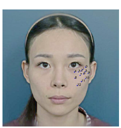 How to Reduce Sagging After Zygoma Reduction or Square Jaw Surgery? (Review of AI Research Findings) image 3