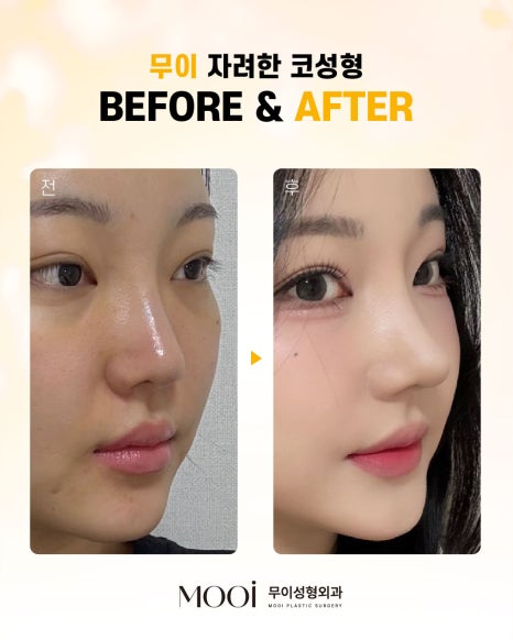 코성형 전후, 무조건 높이는 코보다 관련 이미지 4