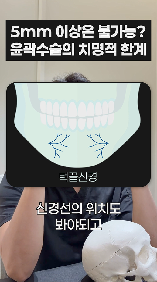 무이성형외과 5mm 이상은 불가능? 윤곽수술의 치명적 한계 관련 이미지 6
