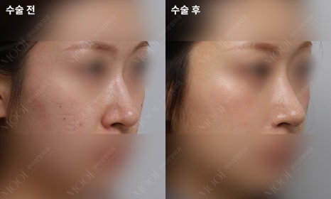 Bulbous Nose Surgery: Is Raising Only the Nose Tip Enough? | Correction Checklist by Cause of Bulbous Nose image 15