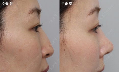 코재수술 늑연골: 자가늑/기증늑(동종늑연골) 어떤 경우에 선택할까 관련 이미지 6