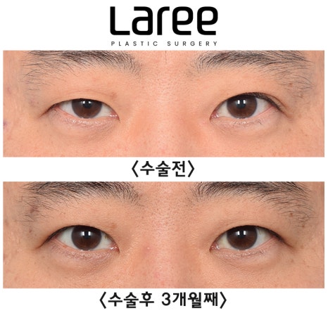 [Lari Plastic Surgery] A Collection of Various Surgeries for Double Eyelids image 9