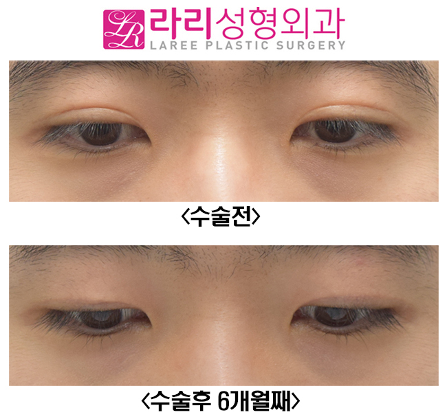 [Rari Plastic Surgery] Eliminating Thick Double Eyelids with a Near-No-Double-Eyelid Inner Fold image 2