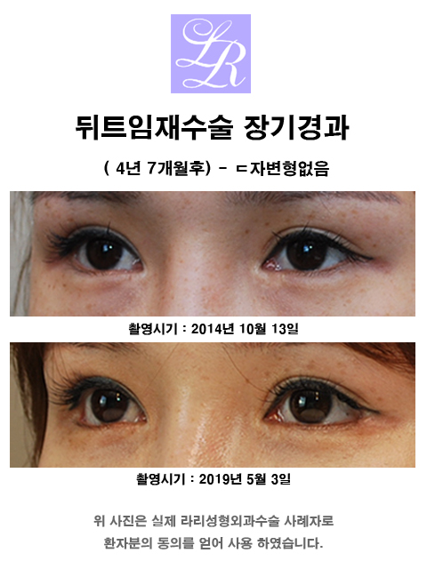 뒤트임재수술 - 첫수술이 효과가 없던 경우, 부작용? 관련 이미지 6