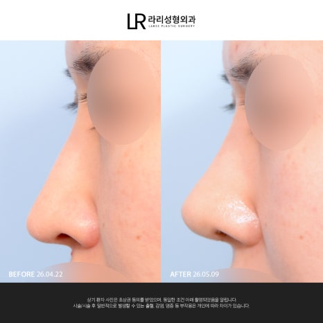 [Lari Plastic Surgery] If You Are Considering Nose Surgery, Do Not Get Nose Thread-Lifting Procedures Like Misko / Hiko!! image 11
