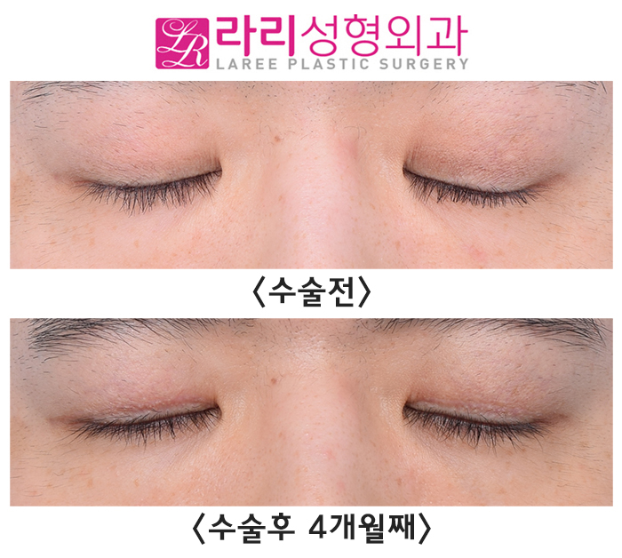 [라리성형외과] 교정과 예방을 모두 위한 쌍꺼풀없애기수술 전후 사진 관련 이미지 4