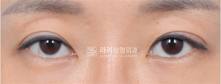 [라리성형외과] 아이홀 꺼짐 있는 눈 파악하고, 윗눈꺼풀 지방이식으로 교정 관련 이미지 8
