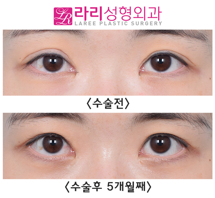 [Lari Plastic Surgery] Lowering the Double Eyelid Line to Near Single Eyelid Level: Before-and-After Photos of a Low Crease Revision image 1