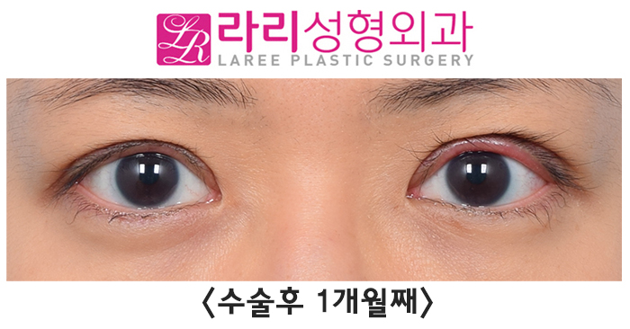 [라리성형외과] 겹주름 쌍꺼풀을 잘 없애려면 피할 수 없는 상안검외반, 좋아질 수 있어요. 관련 이미지 6