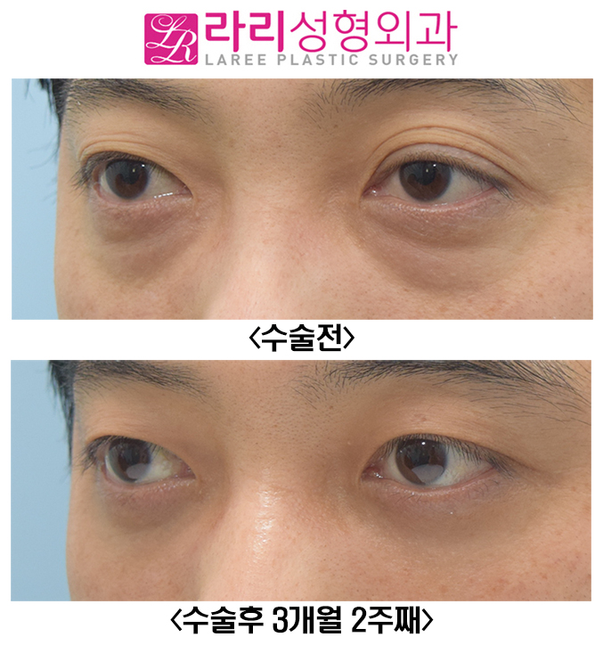 [라리성형외과] 피곤해보이는 여러겹 자연쌍꺼풀없애기와 눈밑지방재배치 수술 전후 관련 이미지 4
