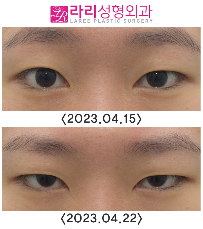 [라리성형외과] 이마보톡스가 눈 모양이나 쌍꺼풀 라인에 미치는 영향에 대하여 관련 이미지 2
