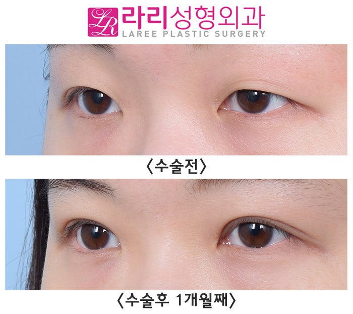 [Lari Plastic Surgery] One-sided Eye Asymmetry Incisional Double Eyelid Surgery with Ptosis Correction: Before-and-After Photos One Month After Surgery image 3