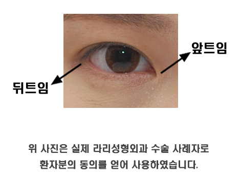 앞트임전후 많이 보면 도움이 될까 관련 이미지 2