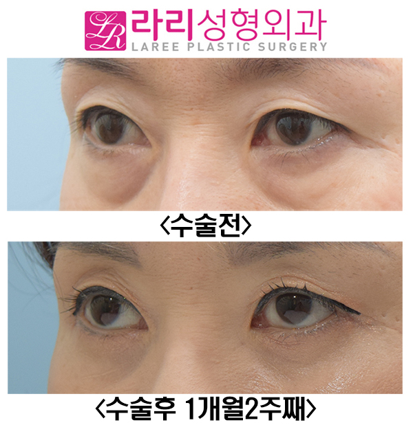 [Lari Plastic Surgery] Short-Term Before-and-After Photos of Lower Blepharoplasty: How to Avoid Ectropion image 4