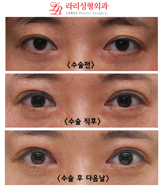 크고 또렷한눈 15분눈매교정 관련 이미지 1