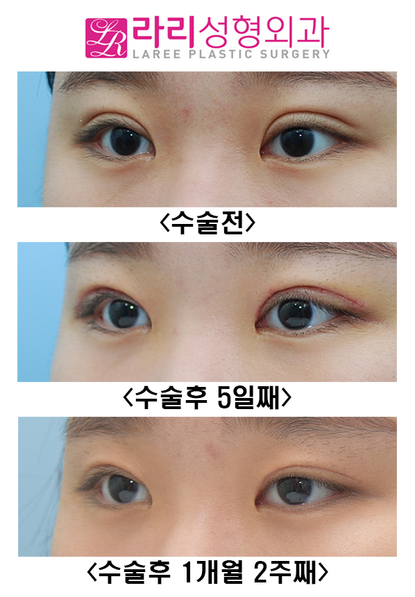 [Lari Plastic Surgery] Revision Double Eyelid Surgery and ROOF Fat Removal image 5