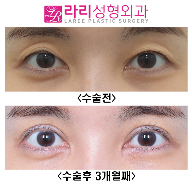 [라리성형외과] 풀린 쌍꺼풀재수술 아웃라인으로 크고 예쁘게 재탄생! 관련 이미지 1
