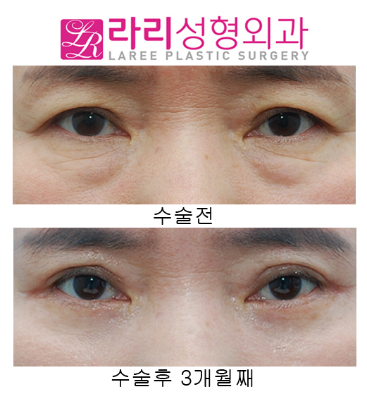 (Middle-aged) Upper Eyelid Surgery and Lower Eyelid Surgery at the Same Time image 1