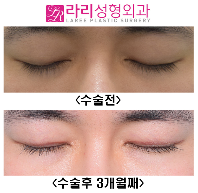 [Lari Plastic Surgery] Is it possible to have a distinct eye even with a hidden double eyelid?! (I don’t want uneven eyes) image 5