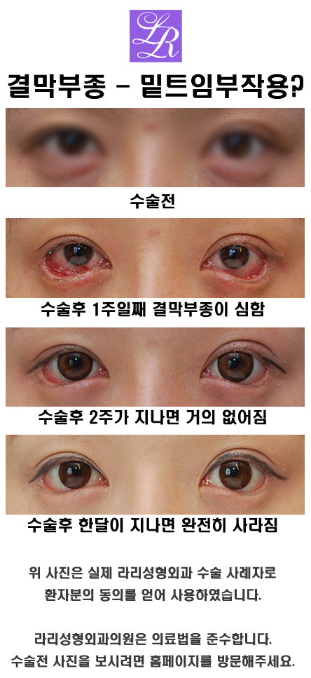 If You're Curious About Side Effects of Lower Eye Corner Surgery (feat. Conjunctival Edema) image 6